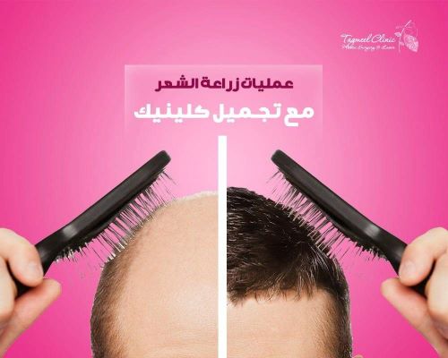 تكلفة زراعة الشعر في مصر